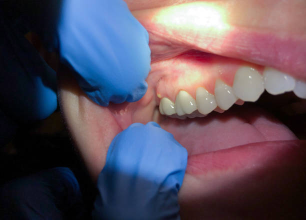 Best Broken or Chipped Tooth Repair in Spring Valley Village, TX